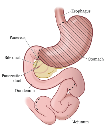 Рисунок 4. Пищеварительная система до тотальной гастрэктомии