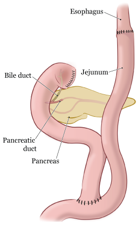 Рисунок 5. Пищеварительная система после тотальной гастрэктомии