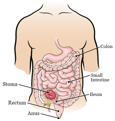 Figure 2. Ileostomy stoma