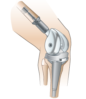 Рисунок 2.  Пример протеза