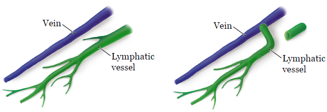 Figure 1. Rerouting a blocked lymphatic vessel