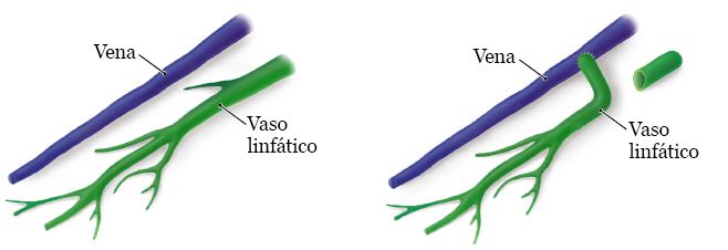 Figura 1. Cómo conectar un vaso linfático dañado a una vena