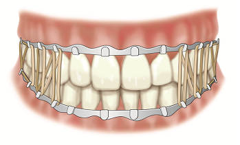 Figure 2. Arch bars and rubber bands