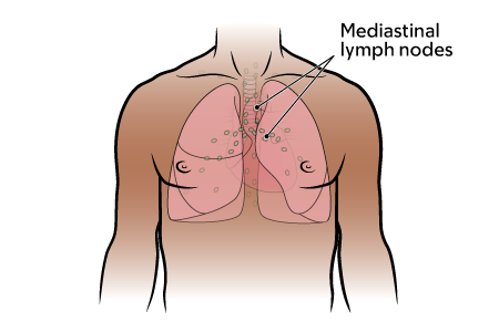 Figure 2. Your mediastinal (chest) lymph nodes