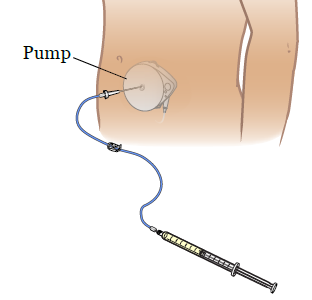 Figure 3. Refilling your pump