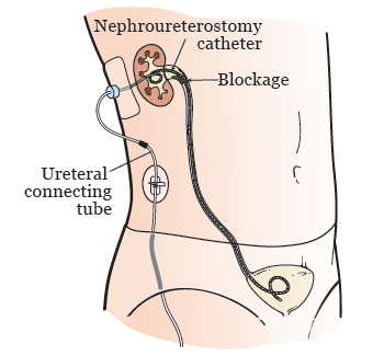 Nephrostomy tube placement complications of diabetes morningstar investing styles matrix cast