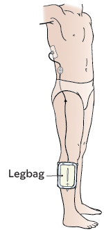 Рисунок 8.  Катетер с носимым ножным мочеприемником
