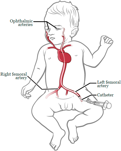 Figure 1. Inserting the catheter