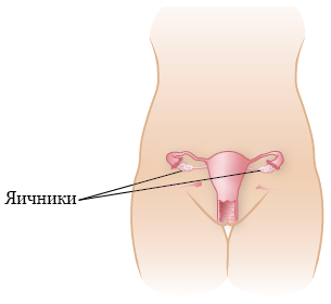 Рисунок 1.  Расположение яичников до операции по транспозиции