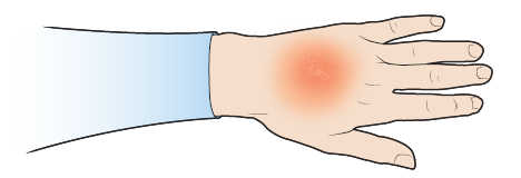 Figure 2. An example of a skin reaction