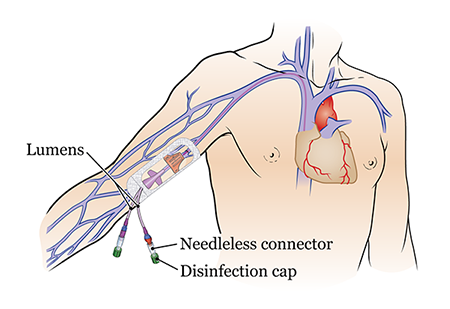 How To Draw Blood In Picc Line How To Draw Blood In Picc Line