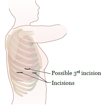 Figure 2. Incision site(s)