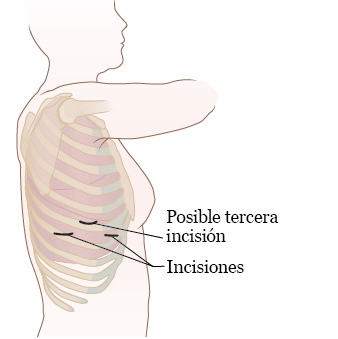 Figura 2. Sitios de incisión