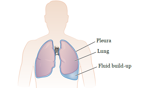 Figure 1. Your lungs and pleural space