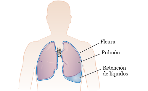 Figura 1. Los pulmones y el espacio pleural