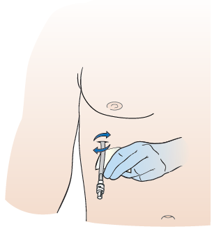 Figure 13. Clean around the catheter