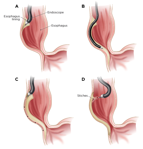 Figure 3. Steps of POEM procedure