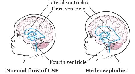 Figure 1. Brain with and without hydrocephalus