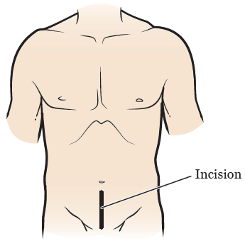 Figura 2. Incisiones de la prostatectomía abierta