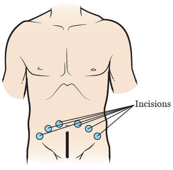 Figura 3. Incisiones de la prostatectomía robótica o laparoscópica