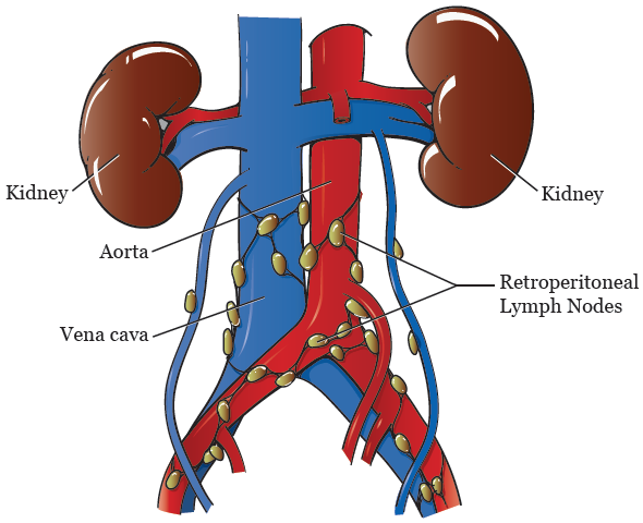 图 1. 腹膜后淋巴结