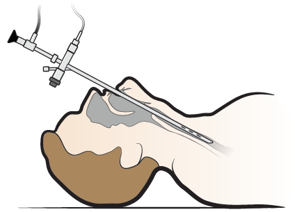 Figure 1. Inserting the bronchoscope