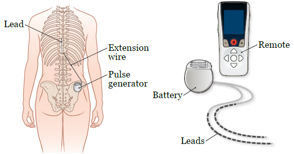 Pain Relief via a Spinal Cord Stimulator