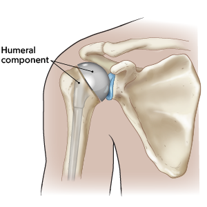 Figura 2. Reemplazo parcial de hombro con componente humeral