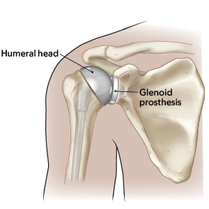 Рисунок 3.  Полная замена плечевого сустава с установкой протеза суставной впадины