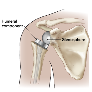 Figure 4. Reverse shoulder replacement with glenosphere