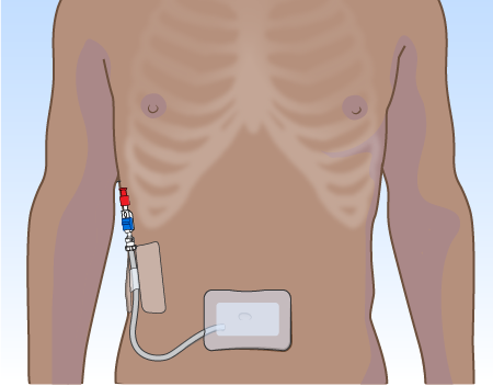 Figure 1. Your Tenckhoff catheter