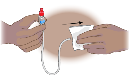 Figure 5. Clean the exit site and skin around it with a gauze pad