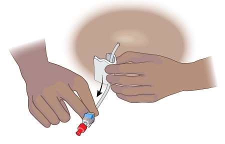 Figure 6. Slide the gauze down the catheter to clean it