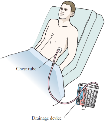 Figure 1. Your chest tube and drainage device