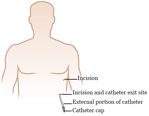 Figure 9. Pleural drainage catheter