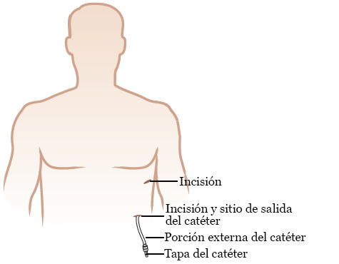 Figura 9. Catéter de drenaje pleural