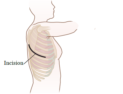 Figure 10. Thoracotomy incision