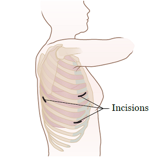 Figure 11. VATS incisions