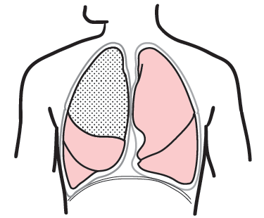 图 4. 肺叶切除术