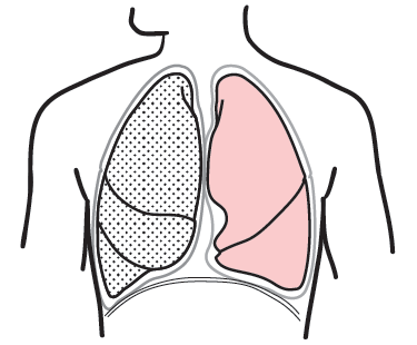 Figure 5. A pneumonectomy