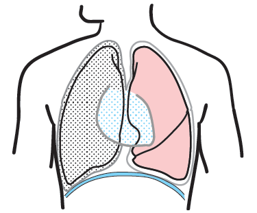 Figura 6.&nbsp;Neumonectomía extrapleural