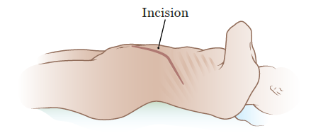 Figura 1. Incisión toracoabdominal