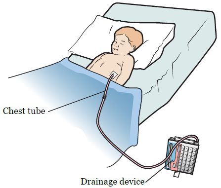 图 3. 胸管和引流装置 