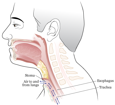 Figure 2. After laryngectomy