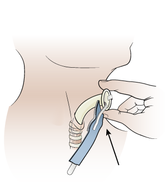 Figure 6. Inserting your laryngectomy tube