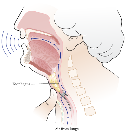 Figure 9. Blocking your stoma for TEP speech (side view)