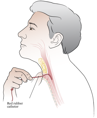 Figure 10. Inserting catheter into TEP tract