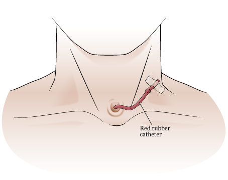 Figure 11. Taping catheter to neck