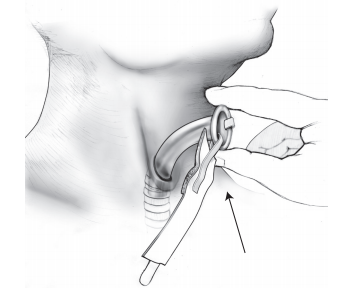 Figura 3. Inserción del tubo de laringectomía