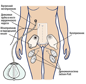 Рисунок 4. Дренажи, стомные мешки и повязки после операции